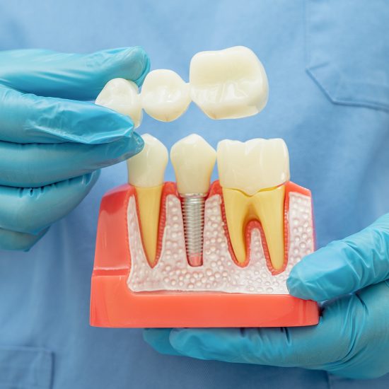 crowns and bridges 550x550