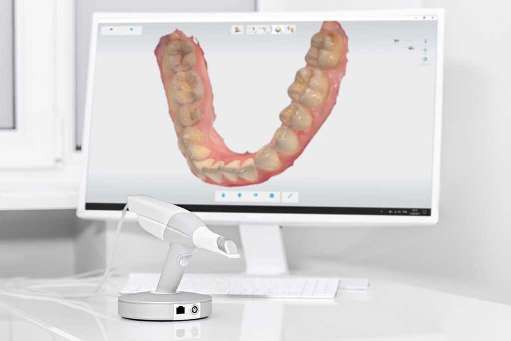 escaner intraoral trios clinica dental torremolinos